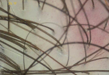 Badanie mikroskopem skóry głowy trycholog Nitecka Zielona Góra