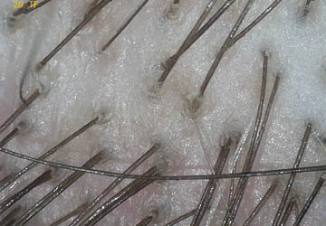 Badanie skóry głowy Trycholog Zielona Góra